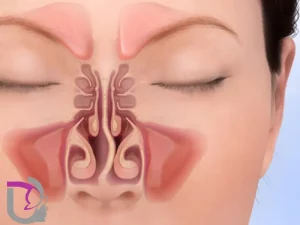جراحی بینی و سینوزیت
