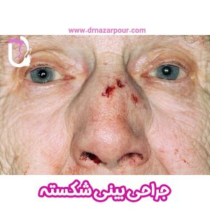 جراحی بینی شکسته