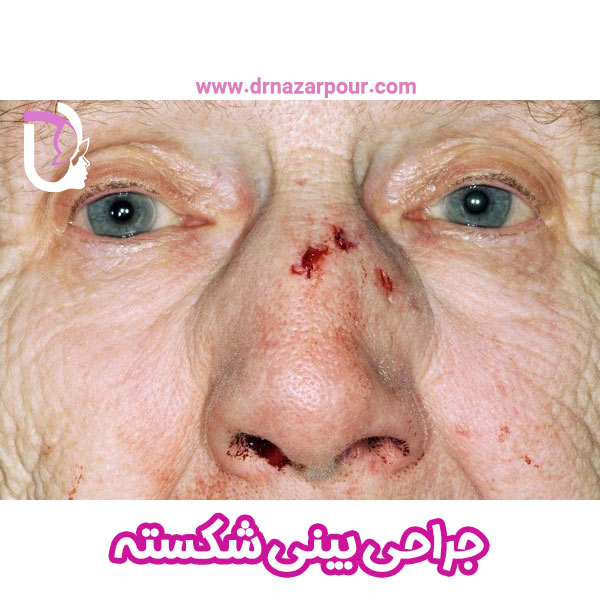 جراحی بینی شکسته