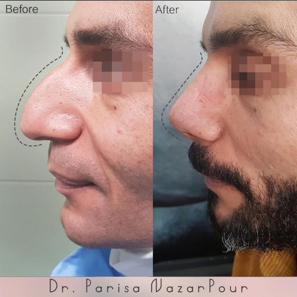 جراحی بینی مردانه در مشهد