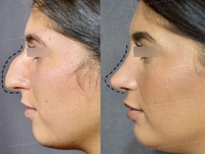 جراحی بینی در افراد دیابتی