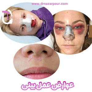 عوارض عمل بینی