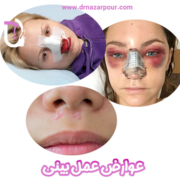 عوارض عمل بینی
