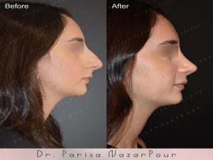 نمونه کار بهترین جراح بینی استخوانی در مشهد