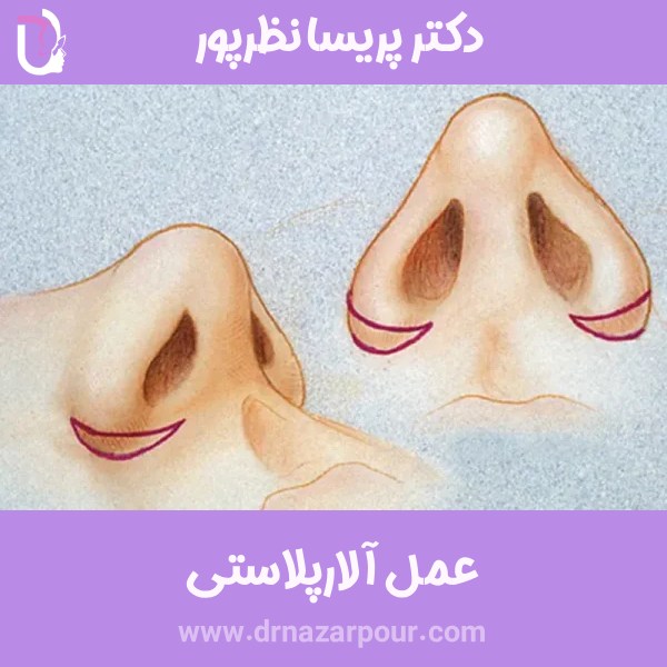 عمل آلارپلاستی