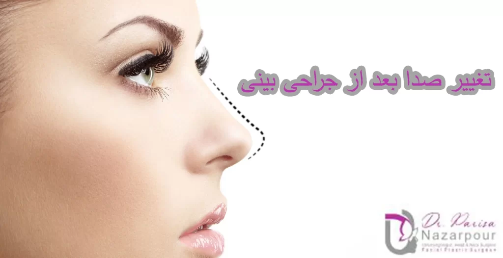 تغییر صدا بعد از جراحی بینی