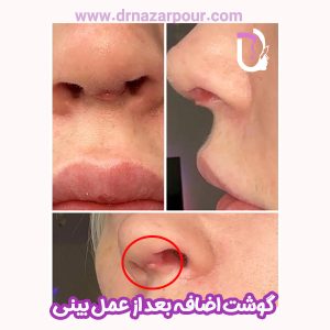 گوشت اضافه بعد از عمل بینی