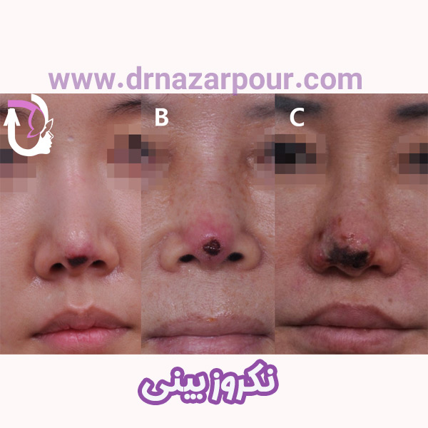 تصاویر نکروز بینی 