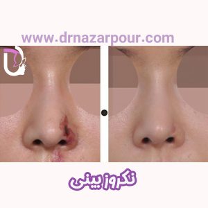 نکروز بینی