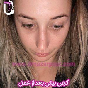 کجی بینی بعد از عمل