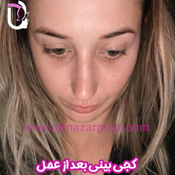 کجی بینی بعد از عمل