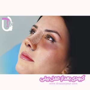 کبودی بعد از عمل بینی