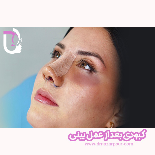 کبودی بعد از عمل بینی