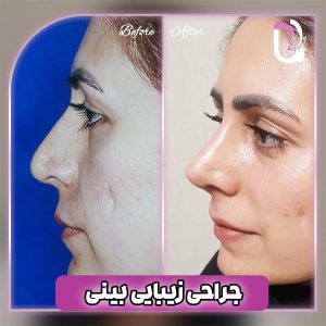 جراحی زیبایی بینی