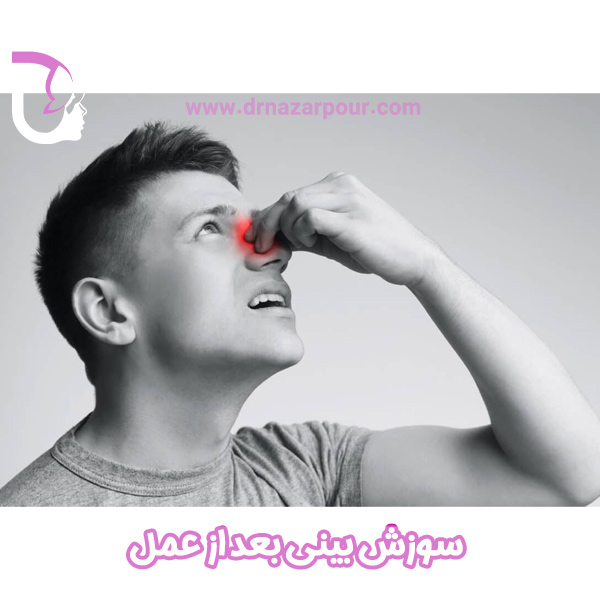 سوزش بینی بعد از عمل
