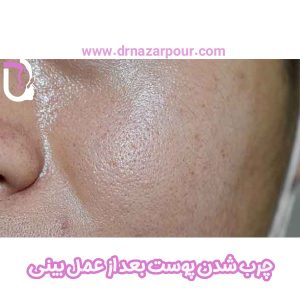 چرب شدن پوست بعد از عمل بینی