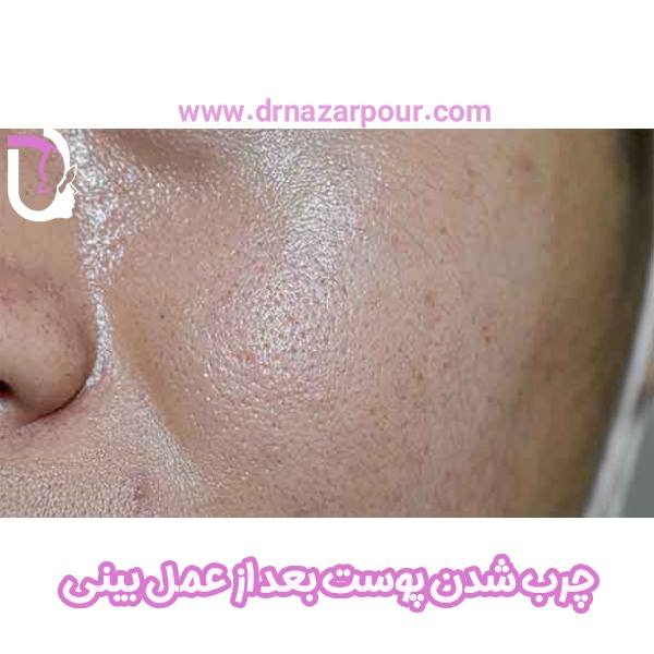 چرب شدن پوست بعد از عمل بینی