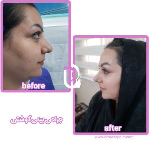 جراحی بینی گوشتی