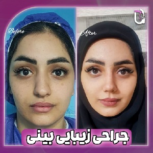نمونه کار بهترین جراح بینی مشهد