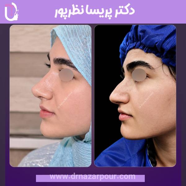 جراحی بینی استخوانی