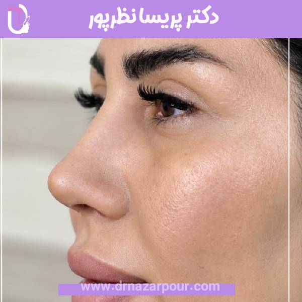 جراحی بینی استخوانی