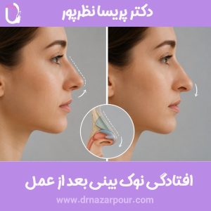 افتادگی نوک بینی بعد از عمل