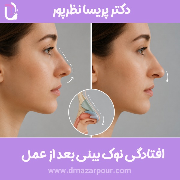 افتادگی نوک بینی بعد از عمل