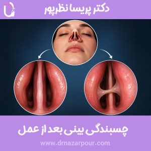 چسبندگی بینی بعد از عمل