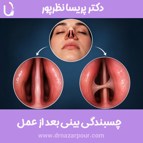چسبندگی بینی بعد از عمل