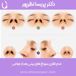 عدم تقارن سوراخ های بینی بعد از جراحی