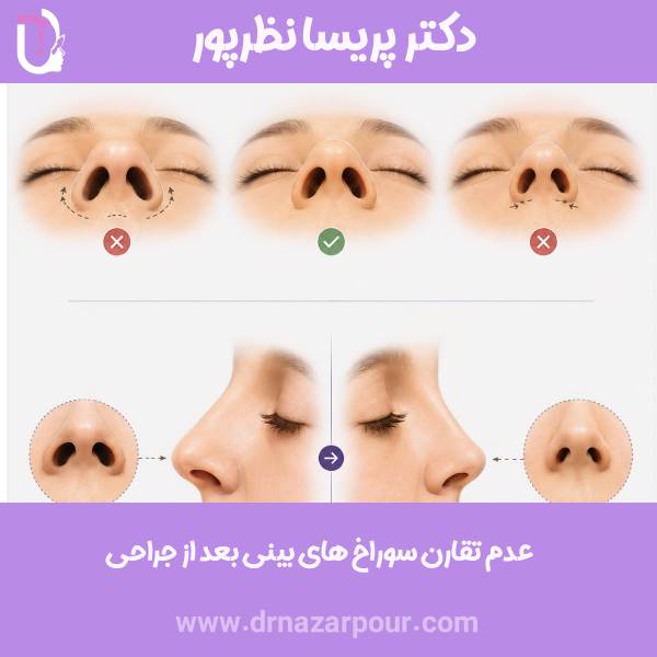 عدم تقارن سوراخ های بینی بعد از جراحی
