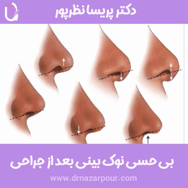 بی حسی نوک بینی بعد از جراحی