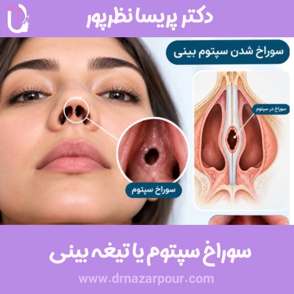 سوراخ تیغه یا سپتوم بینی